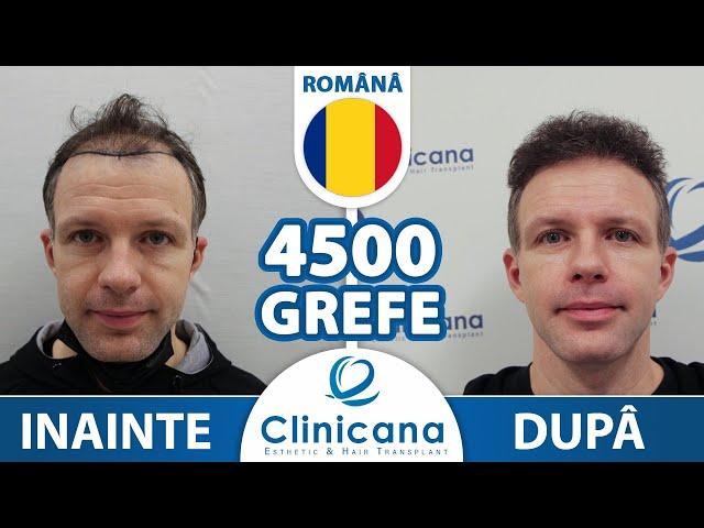 Implant de păr Turcia. Rezultatul si experienta dl-ui Stefan din Romania