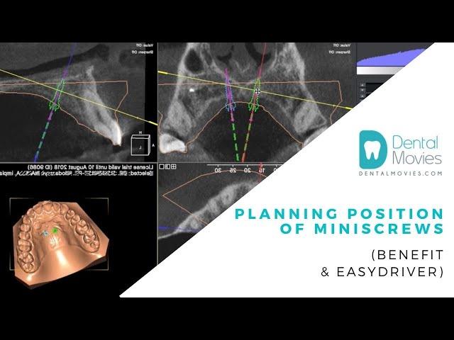 PLANNING POSITION of MINISCREWS   (BENEFIT & EASYDRIVER)