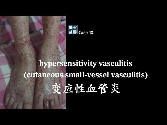 hypersensitivity vasculitis, cutaneous small vessel vasculitis CSVV, 变应性血管炎