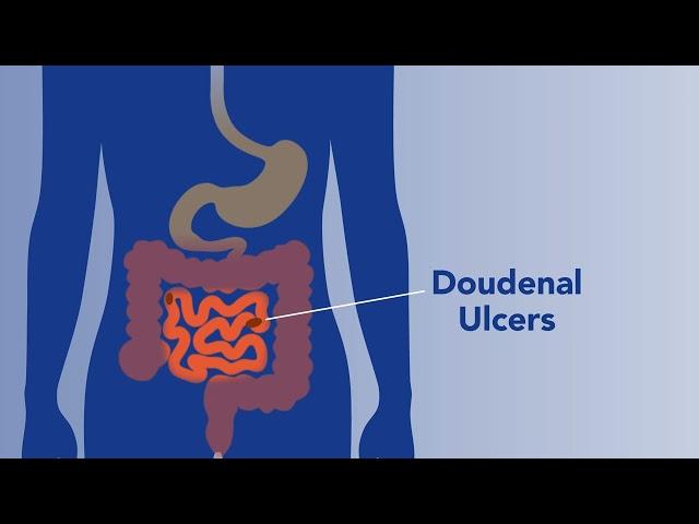 Common Digestive Ailments - Peptic Ulcer Disease