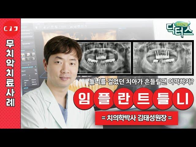 틀니 대신 선택할 수 있는 다양한 선택지, 확인해요~