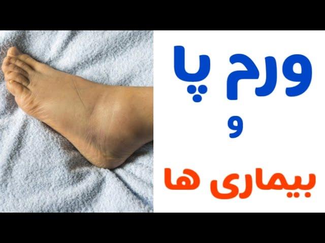 بیماری هایی که خودشون رو با ورم پا نشون میدن / دکتر نکته