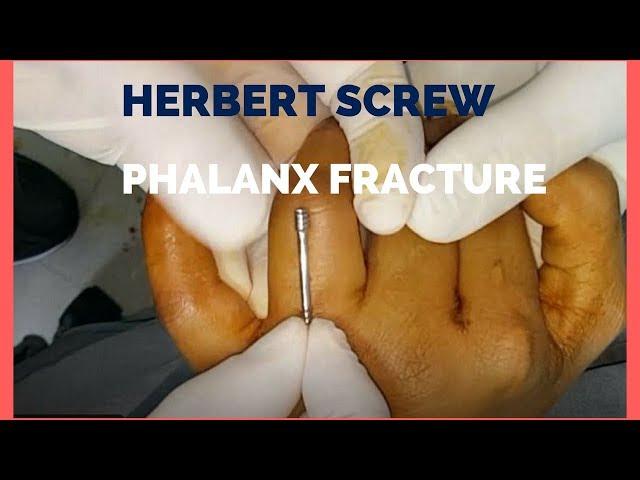 Phalanges - Herbert Screw