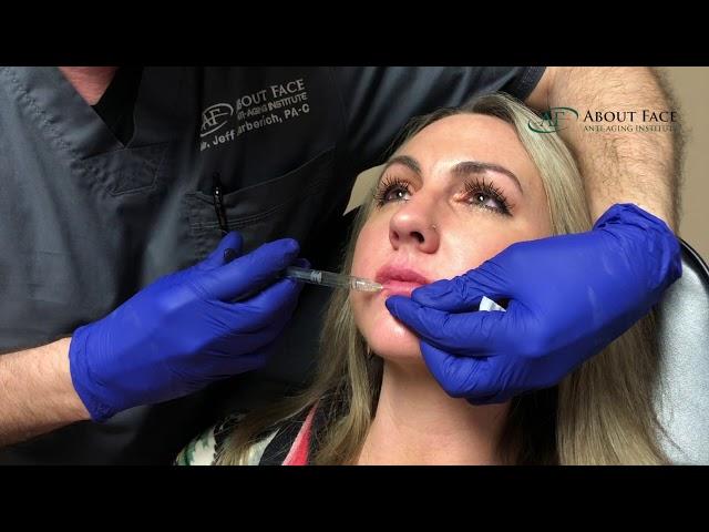 Juvederm Ultra Lip Filler Treatment Video