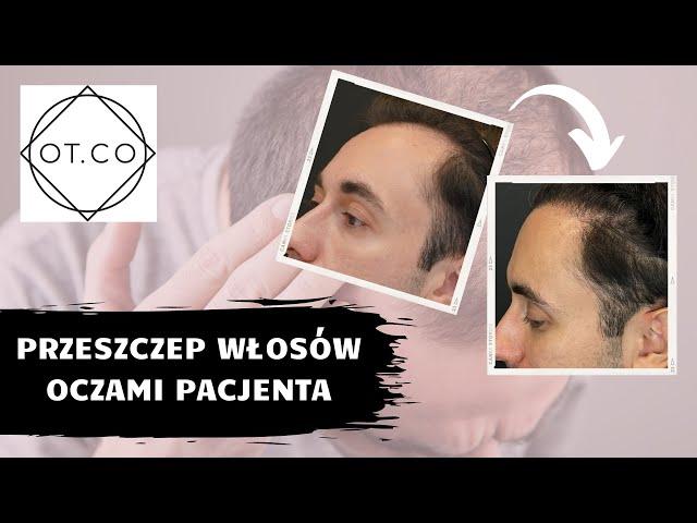 Przeszczep włosów oczami pacjenta - OT.CO Clinic