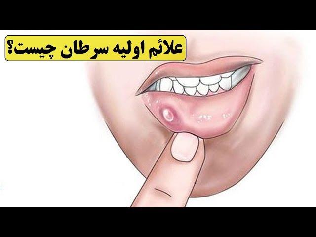 ۲۰ مورد از  ضعف ایمنی بدن و مهمترین علائم اولیه سرطان چیست؟