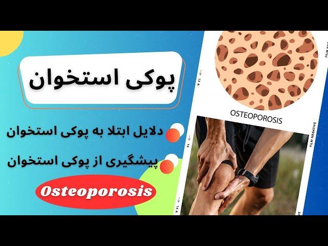 بیماری پوکی استخوان،دلایل ابتلا و راه های درمان پوکی استخوان (Osteoporosis)