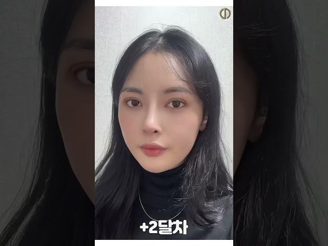 눈성형, 코성형, 안면윤곽 1년 성형후기 #눈재수술 #트임 #눈밑지방재배치 #코성형 #안면윤곽 #지방이식