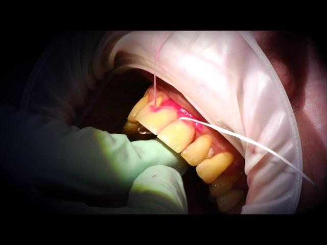 Caring for Dental Implants - Cross-over Floss Technique