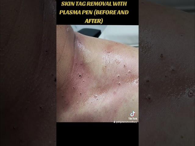 SKIN TAG REMOVAL WITH PLASMA PEN. (BEFORE AND AFTER)