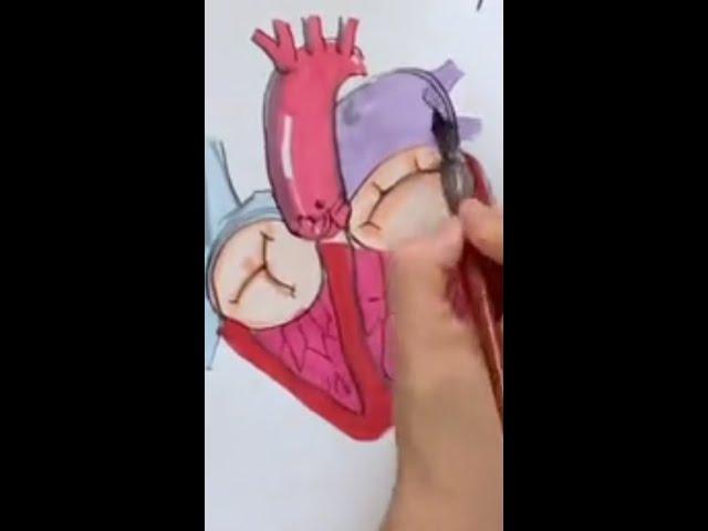 Mitral Regurgitation and KISS Repair: A Doodle Journey