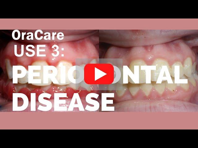 OraCare Use 3: Periodontal Disease