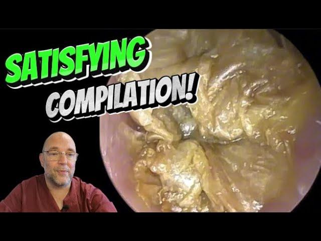 SATISFYING COMPILATION! 319 #ear #earwax #earwaxremoval #fyp #satisfying #foryou #fyp #foryourpage