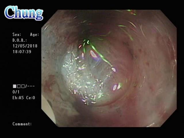 ESD for early gastric cancer