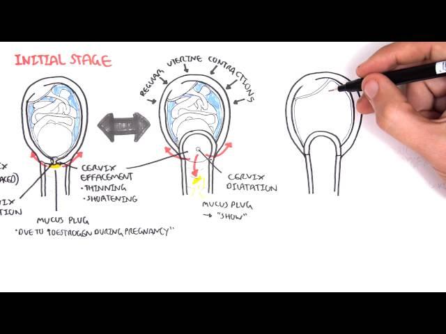 Obstetrics - Stage I of Labour