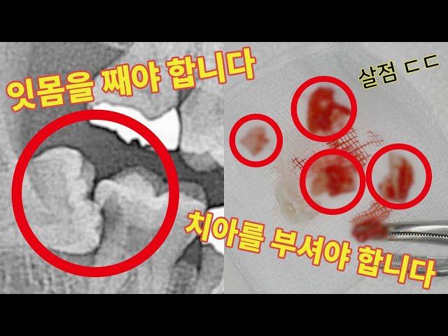 사랑니 발치.. 그 실체를 파헤치다 (feat. 교대 예미안 치과의 송정현 원장)