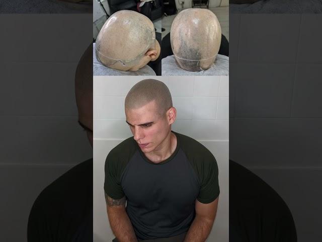 Scalp Micropigmentation For Alopecia  #scalpmicropigmentation #alopecia #hairtattoo #hairloss