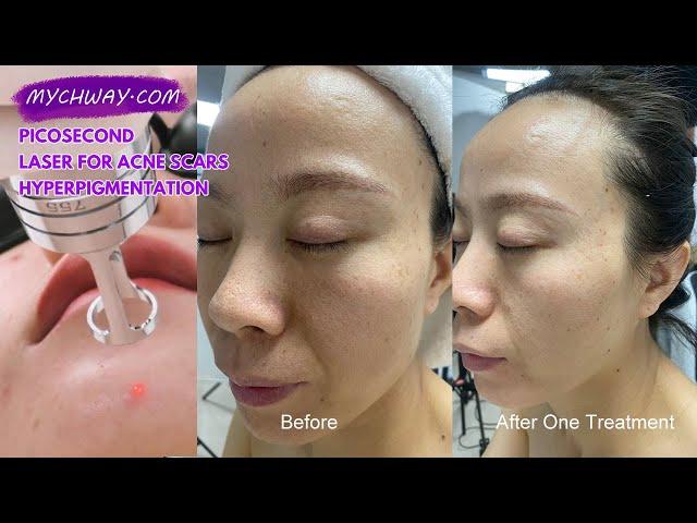 Picosecond Laser for Acne Scars & Hyperpigmentation: Before & After | Erasing Your Acne Scars | AS60