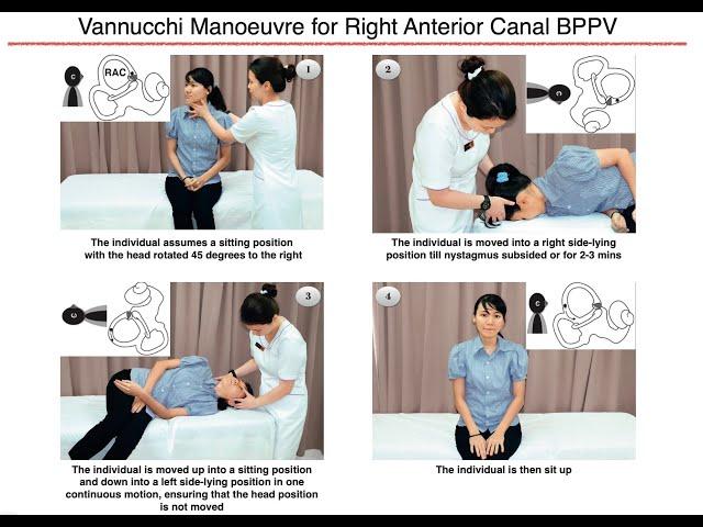 Vannucchi Manoeuvre for Right Anterior Canal BPPV