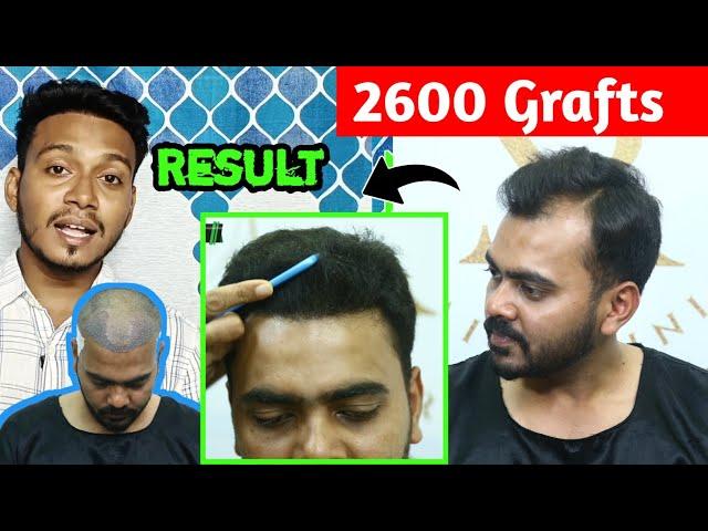 Only 2600 Grafts On Grade 3 Boldness !! Hair Transplant