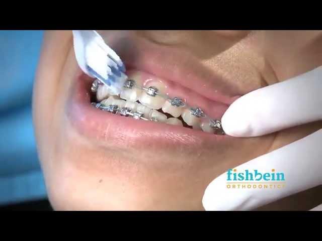 Orthodontic Home Care Instructions | Braces | Brushing