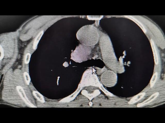 CT GE brief parameters for Pulmonary Angio, PE study,