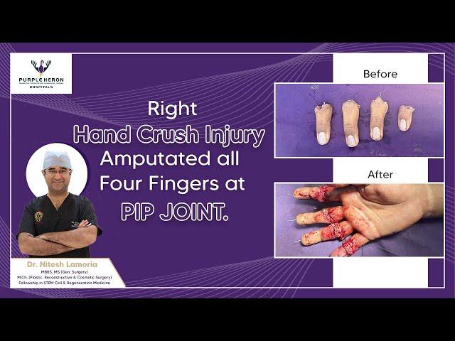 Emergency Hand Surgery: Replantation of Four Traumatic Amputated Fingers