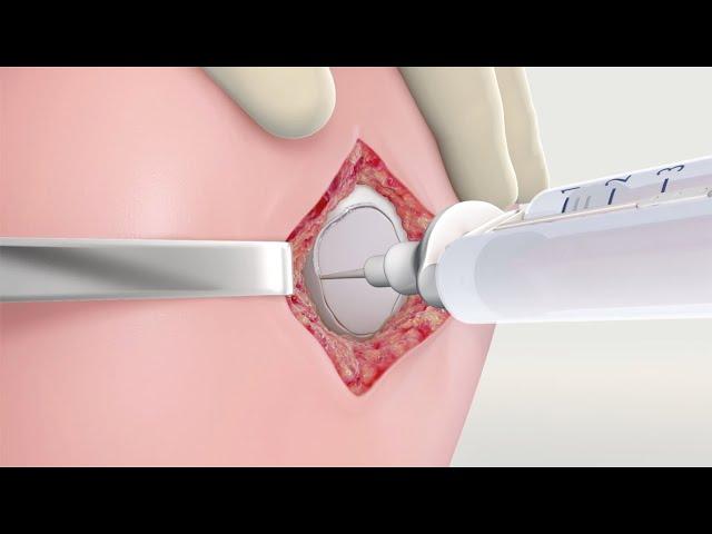 MACI Surgical Animation: Surgical Technique