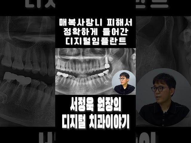 매복사랑니 피해서 정확하게 들어간 디지털임플란트#디지털임플란트 #사랑니 #사랑니발치 #발치즉임플란트 #치과 #digitalimplant #dentist #implant