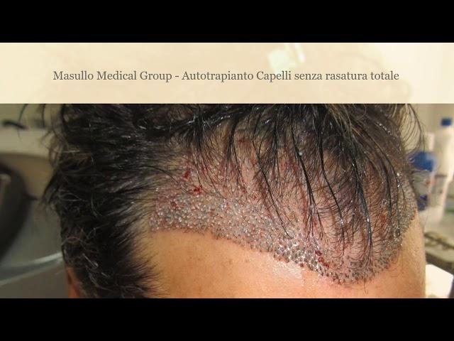 Trapianto Capelli Fue Senza Rasatura Capelli