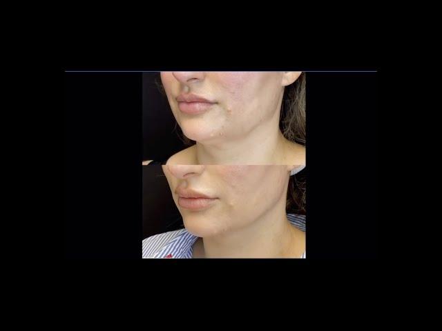 Lipo - Stubborn Under Chin Fat treatment - Ageless MD