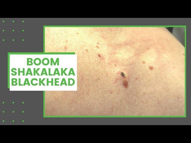 Boomshakalaka Blackhead | Dr. Derm