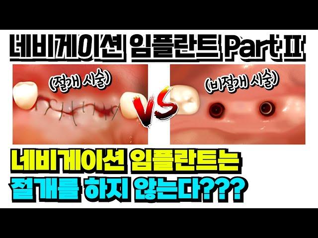 네비게이션 임플란트 Part II - 네비게이션 임플란트는 절개를 하지 않는다???