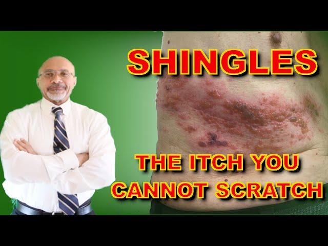 Shingles (Why The Itch Is Hard To Treat)