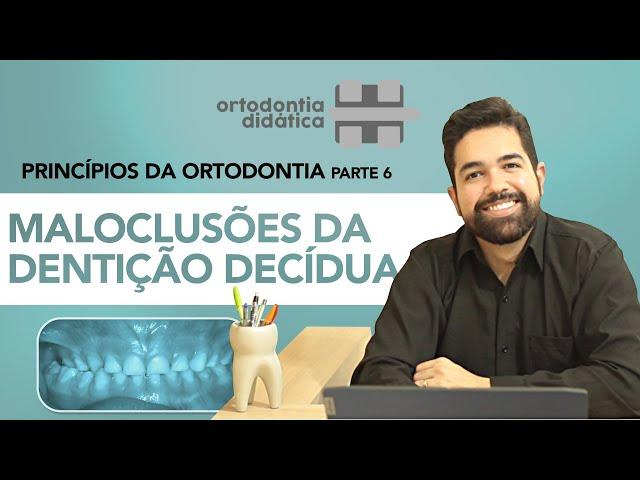 MALUCLUSÕES DA DENTIÇÃO DECÍDUA - Princípios da Ortodontia - Parte 6