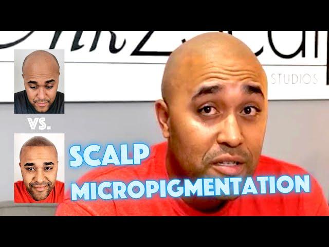 See Andre's Scalp Micropigmentation Transformation with Ink 2 Scalp Studios in Ontario