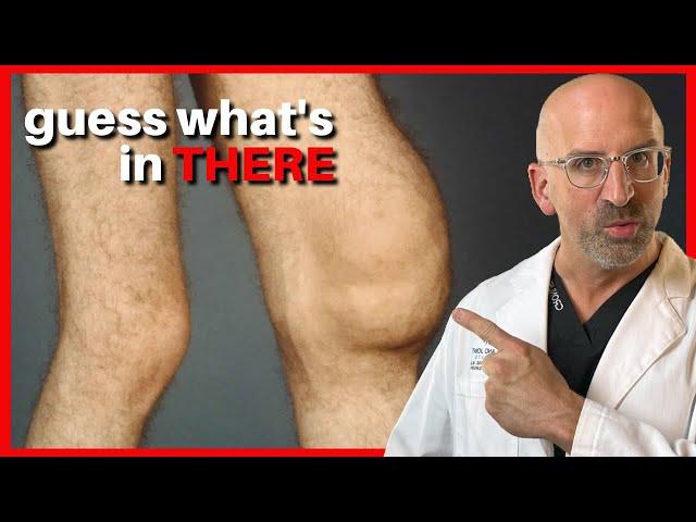 SWOLLEN Joint - What's in there?  #shorts