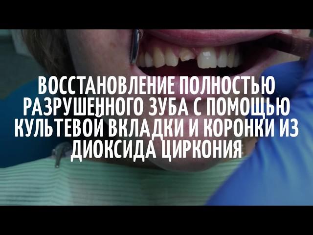 Восстановление полностью разрушенного зуба с помощью культевой вкладки и коронки из циркония