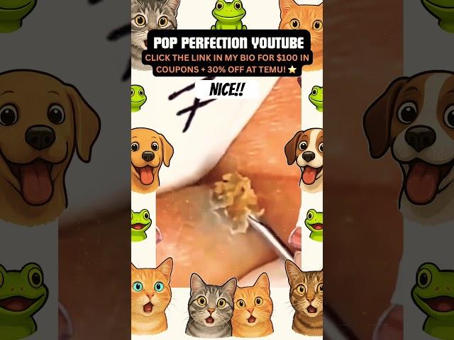 Wow! #youtubeshorts #youtube #shortsfeed #shortvideo #shorts #short #pimple #pimplepopping #pimples