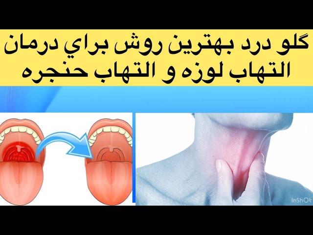 گلو درد چيست؟ بهترين روش براي درمان التهاب لوزه و التهاب حنجرهSore throat treatment