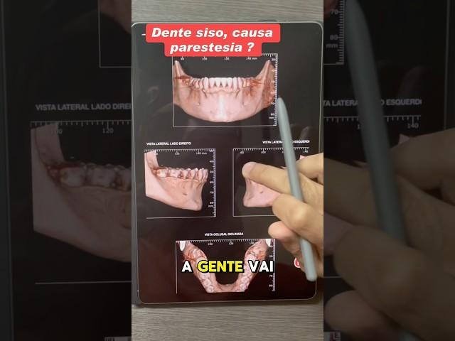 Não arranque Dente Siso sem Tomografia . #dentista #tomografia