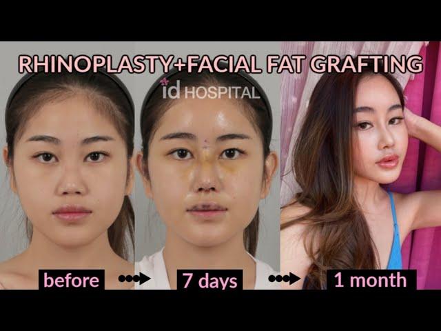 Rhinoplasty and Fat grafting review VLOG  ID hospital