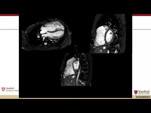 MonteHeart Multimodality Imaging Lecture with Shiraz Maskatia, MD