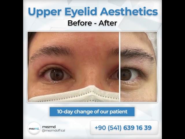 Upper Eyelied (Blepharoplasty) Surgery - Before & After | mezMD Health Tourism Agency