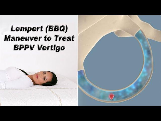 Lempert (BBQ) Maneuver to Treat BPPV Vertigo