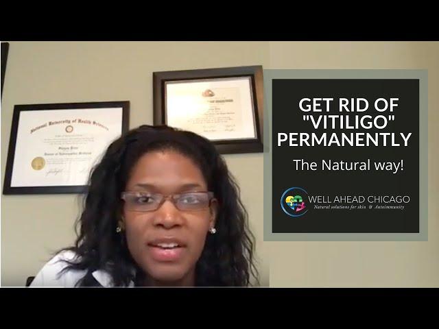 How to Cure #Vitiligo | Get Rid of it Permanently | Does Natural Treatment Really Work? |