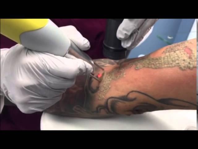 Laser Tattoo Removal (Full Sleeve) Skin Deep Laser Services,Burke VA, Fairfax County VA, Northern VA