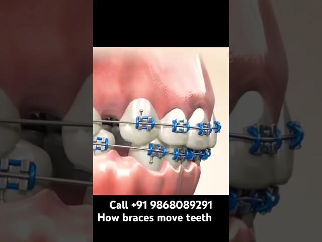 ‼️OFFER‼️Braces start 35000/- #braces #dental #cosmetic #tech #dentist #smile #makeover #invisalign