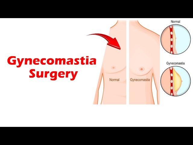 Gynecomastia Surgery POST-OP Result !! Dr. Prashant Yadav