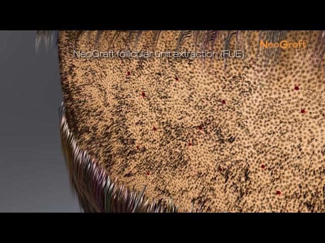 NeoGraft Hair Transplant System Explained   Follicular Unit Extraction FUE HD HD1